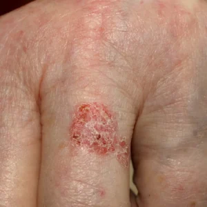 Bowen Disease