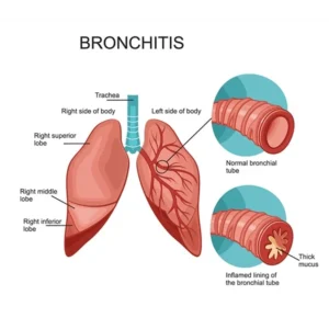 Bronchitis