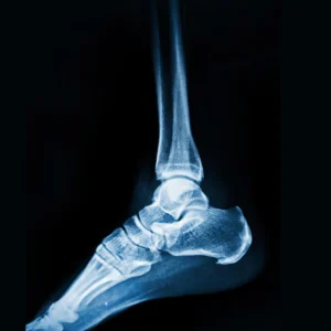 Calcaneal Spur