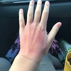 Cellulitis