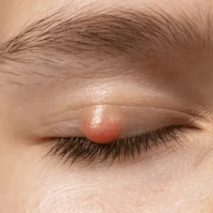 Chalazion