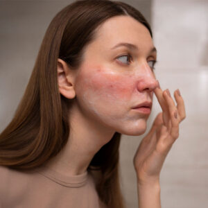 Acne Rosacea