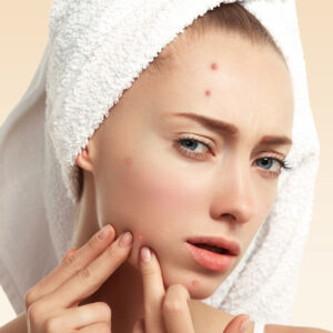 Acne-What Why and Management