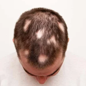 Alopecia Areata