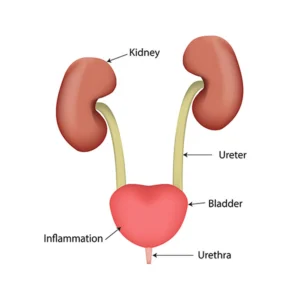 Cystitis