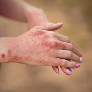 Eczema / Allergic Dermatitis / Skin Allergies