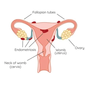 Endometriosis