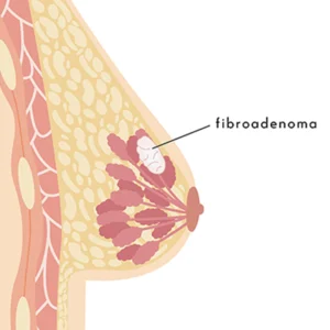 Fibroadenoma (Tumours) Breast