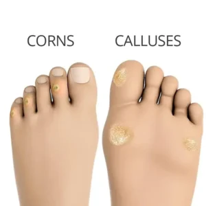 Corns