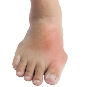 Gout